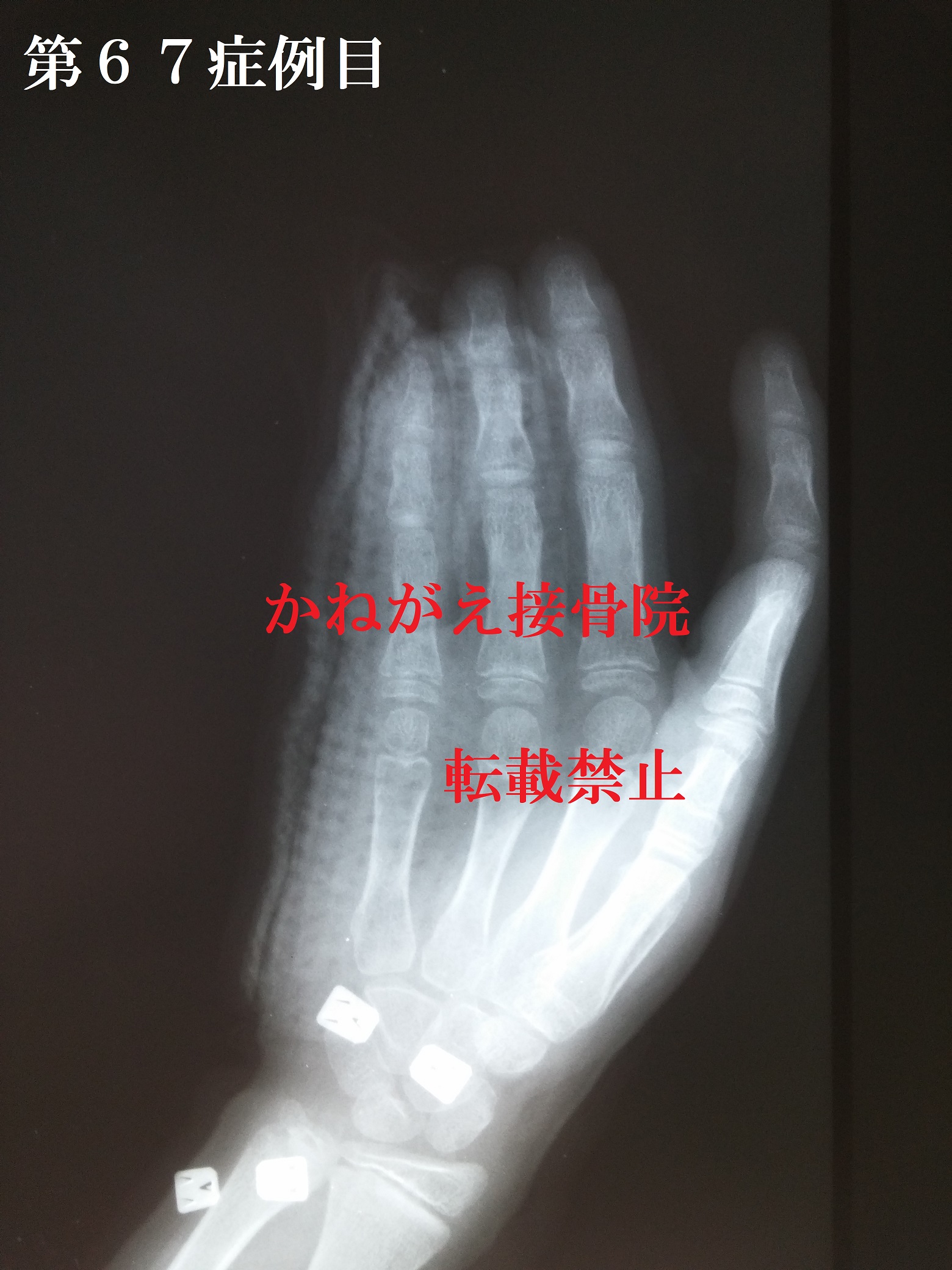 UVǗRepoP